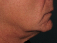 Before Ultherapy skin tightening - San Diego Dermatology and Laser Surgery